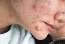 Photo of Secret: Get Rid Of Acne (Pimples) Completely