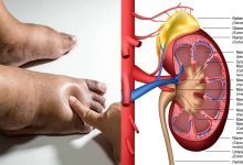 Photo of 6  THINGS  YOU DO THAT CAUSES KIDNEY DISEASE YOU DON’T KNOW