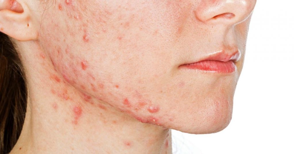 Secret: Get Rid Of Acne (Pimples) Completely - Health GadgetsNG