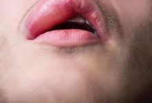 Photo of SIMPLE CURE TO SWOLLEN LIPS