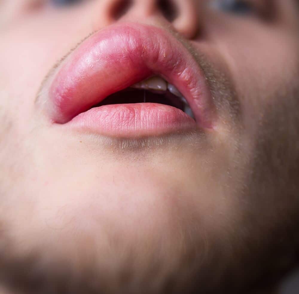 Swollen lips home remedies for Swollen Lip