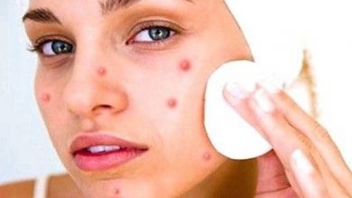 Photo of HOME REMEDIES TO ELIMINATE PIMPLES NATURALLY