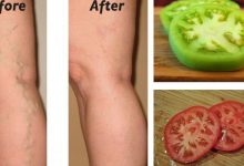 Photo of Home Remedy for Varicose Veins
