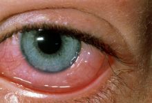 Photo of TIPS TO HELP YOU TACKLE EYE ALLERGIES