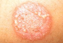 Photo of 2 DAY HOME REMEDY FOR RINGWORM