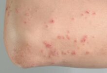 Photo of EFFECTIVE HOME REMEDY FOR HIVES