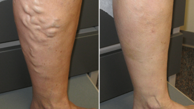 Photo of NATURAL REMEDIES AND PREVENTION OF VARICOSE VEINS