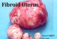 Photo of 2 WEEKS HOME REMEDY FOR LONG TIME FIBROID
