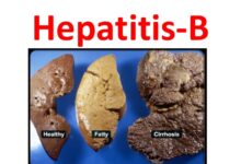 Photo of HEPATITIS – B EVERY THING YOU NEED TO KNOW