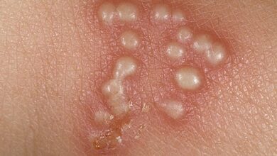 Photo of 7 NATURAL HOME REMEDIES FOR WARTS