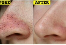 Photo of 5  EFFECTIVE WAYS TO REMOVE BLACK HEADS PIMPLE IN 2 DAYS