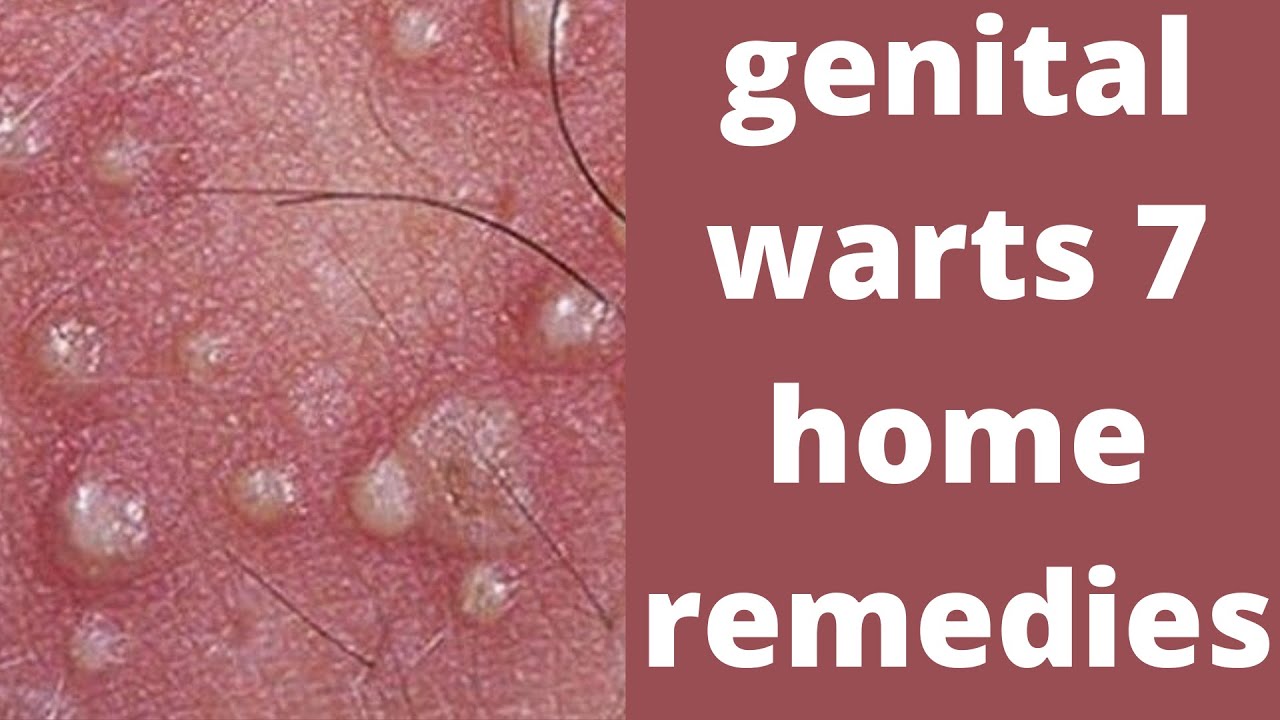 Natural treatment for hpv warts