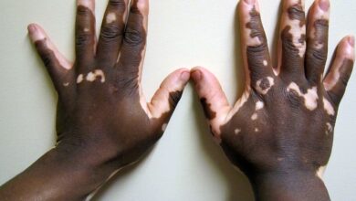 Photo of 7 EFFECTIVE HOME REMEDIES FOR VITILIGO TO REDUCE PESKY WHITE PATCHES