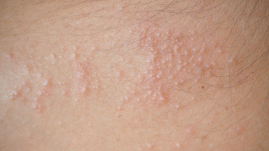 Photo of 11 NATURAL WAYS TO GET RID OF HEAT RASHES