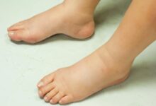 Photo of NATURAL HOME REMEDY FOR SWOLLEN FEET