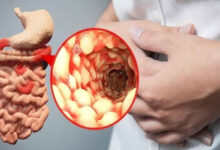 Photo of Treatment For Crohn’s Disease (intestinal disorder)