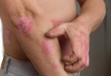 Photo of How To Get Rid of Psoriasis (skin disease)
