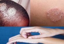 Photo of HERBAL REMEDY FOR TREATMENT OF RINGWORM