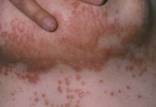 Photo of GET RID OF HEAT RASHES UNDER BREAST