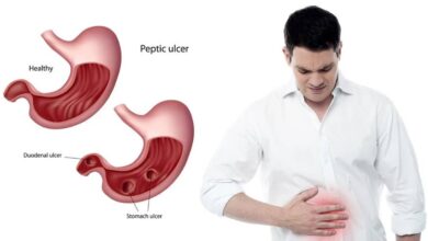 Photo of 5 DAYS SURE NATURAL CURE FOR ULCER