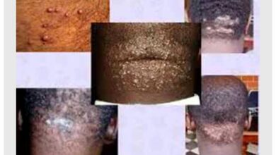 Photo of TREAT KELOIDS, PIMPLES BEHIND THE NECK