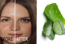Photo of QUICK SOLUTION REMEDY FOR FACE PIMPLE