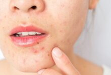Photo of 5 GREAT HOME REMEDIES FOR PIMPLES AND PROBLEMATIC SKIN