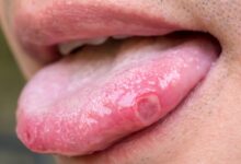 Photo of HOME REMEDIES FOR SORE OR TONGUE BLISTERS