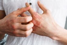 Photo of HOW TO CURE ECZEMA PERMANENTLY