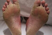 Photo of HOW TO COMBAT FOOT FUNGUS IN 1 WEEK