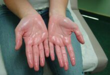 Photo of PREVENTION AND CURE OF EXCESSIVE SWEATING (HYPERHIDROSIS)