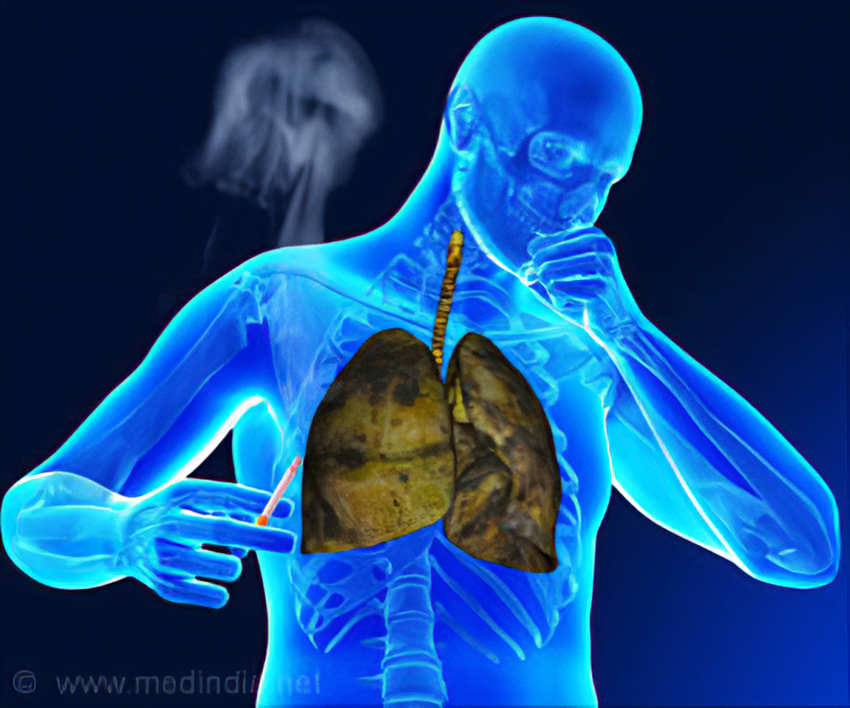 CAUSES AND PREVENTION OF TUBERCULOSIS Health GadgetsNG