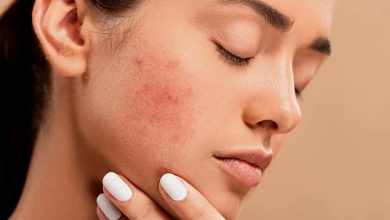 Photo of Teen Acne Is No Joke- Learn More About Proven Acne Treatments