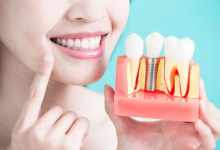Photo of Top 5 Benefits Of Getting Dental Implants
